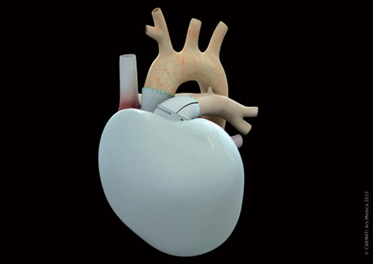 Artificial-Heart