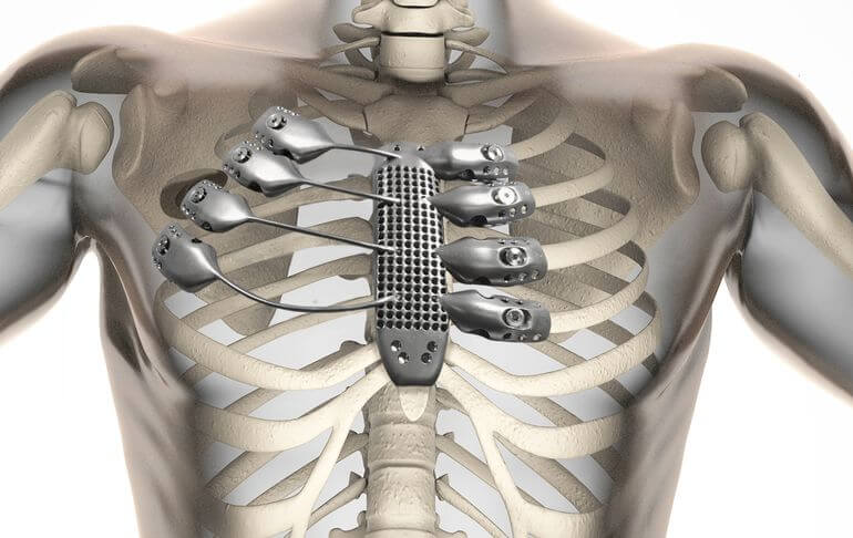 3d-printed-sternum-ribs