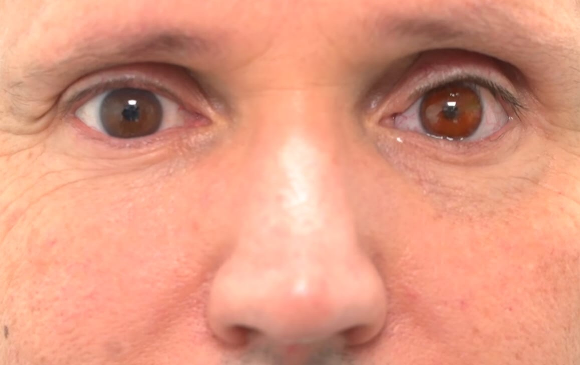 Хирурги впервые в истории вставили человеку напечатанный на 3D-принтере глаз