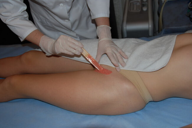 Эпиляция воском и другими методами повышает риск инфекционных заболеваний кожи. Фото.