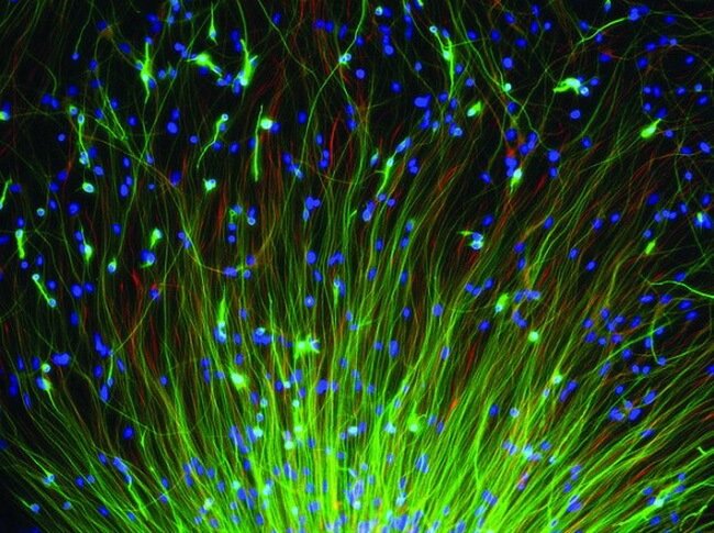 В лечении неврологических проблем помогут стволовые клетки. Фото.
