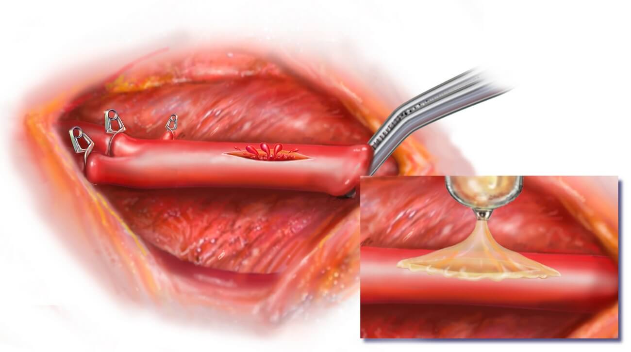 Суперклей для сердца