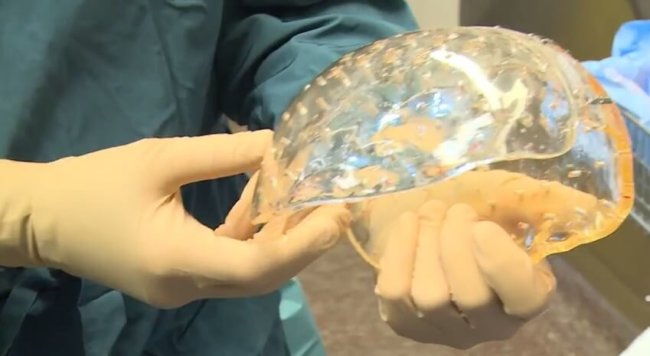 Благодаря технологии 3D-печати женщине пересадили часть черепа. Фото.