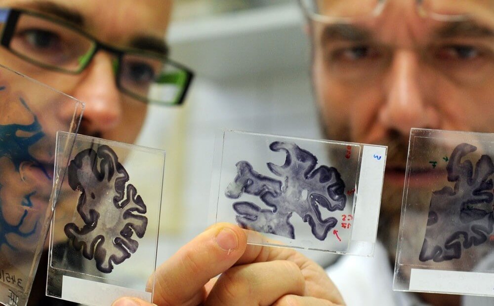 Учёным удалось обратить вспять развитие болезни Альцгеймера