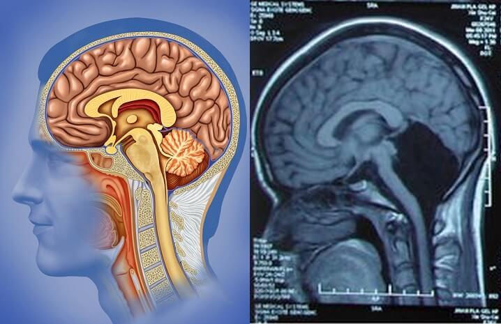 Слева - нормальный мозг, справа - с отсутствующим мозжечком