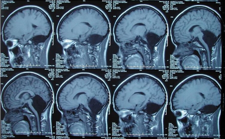Девушка 24 года жила без важного отдела головного мозга