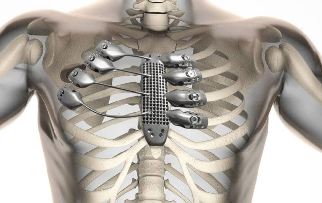 Раковому больному пересадили 3D-напечатанные титановые ребра и грудину. Фото.