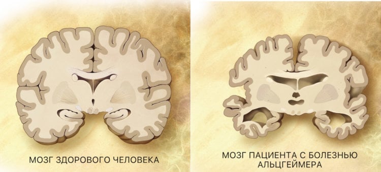 Мозг здорового человека и пациента с болезнью Альцгеймера