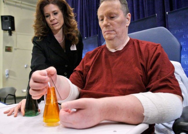Первый американец, перенесший трансплантацию обеих рук, хочет от них избавиться. Фото.