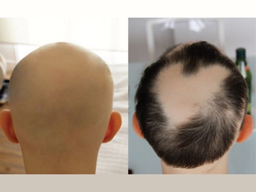 Пациентам с облысением вернули волосы с помощью препарата от ревматоидного артрита