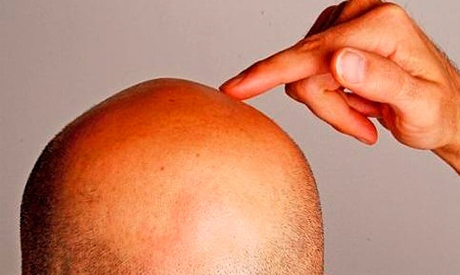 Создан охлаждающий шлем, который спасет от потери волос при химиотерапии