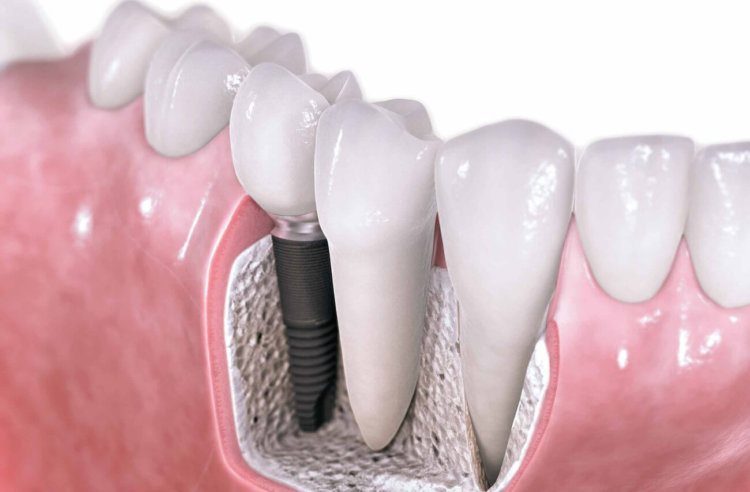 Созданы зубные импланты, которые способны сами врастать в кость. Фото.