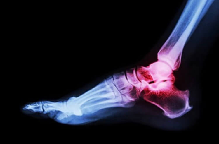 Некоторые люди обладают действительно крепкими костями. Фото.