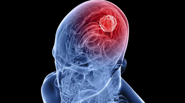 Учёные научились подсвечивать раковые клетки в процессе удаления опухолей. Учёные научились подсвечивать раковые клетки в процессе удаления опухолей. Фото.