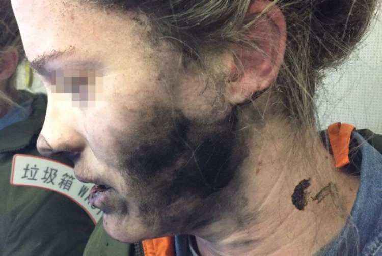 Беспроводные наушники взорвались на голове девушки во время авиаперелёта. Фото.