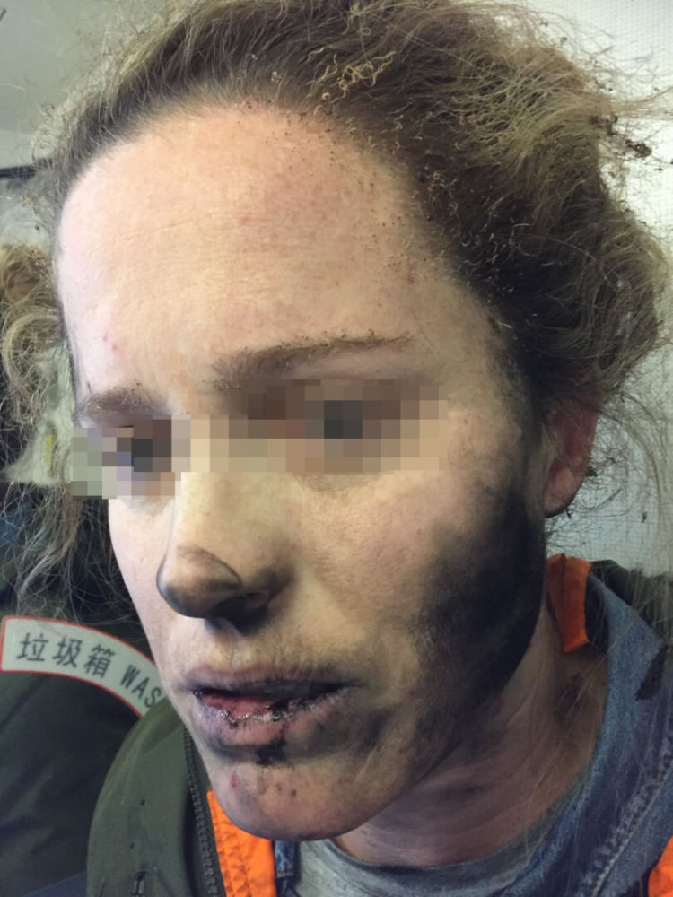 Беспроводные наушники взорвались на голове девушки во время авиаперелёта. Фото.