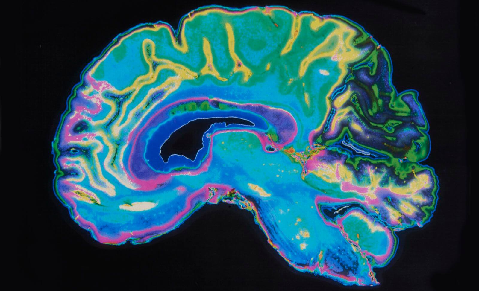 Искусственный интеллект научился выявлять ранние симптомы шизофрении. Искусственный интеллект научился выявлять ранние симптомы шизофрении. Фото.