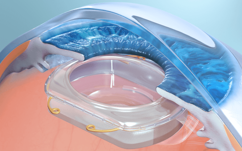 Omega Ophthalmics: Дополненную реальность имплантировать прямо в глаза