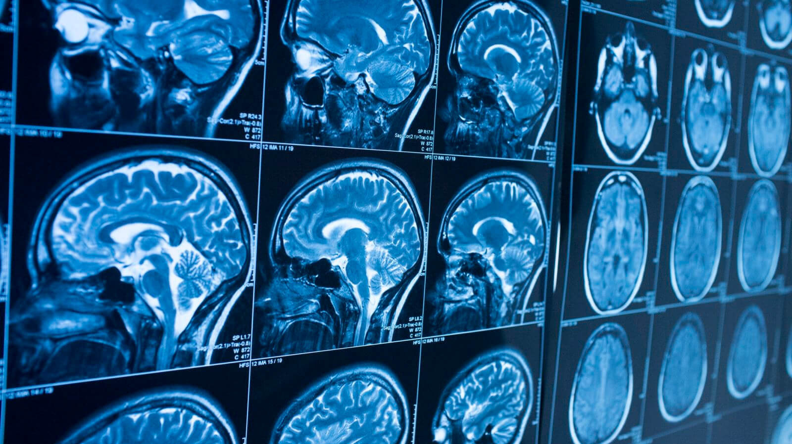 ИИ способен выявить болезнь Альцгеймера за годы до появления симптомов. Фото.