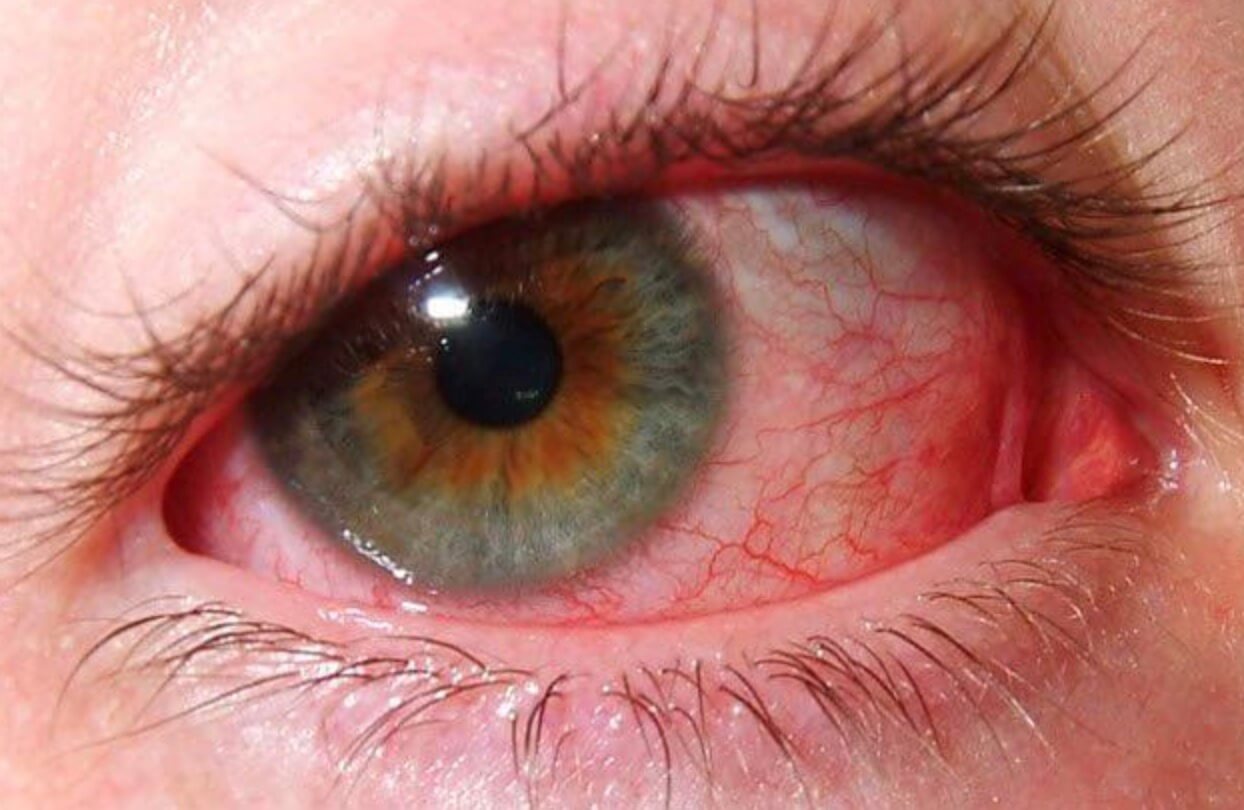 Проблемы с глазами и потеря зрения. Многие недооценивают проблему потери зрения при полете на Марс. Фото.