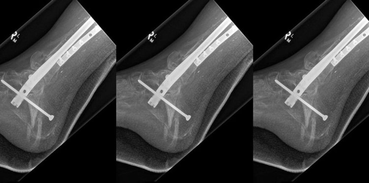 Напечатанную на 3D-принтере берцовую кость имплантировали пациенту. Фото.