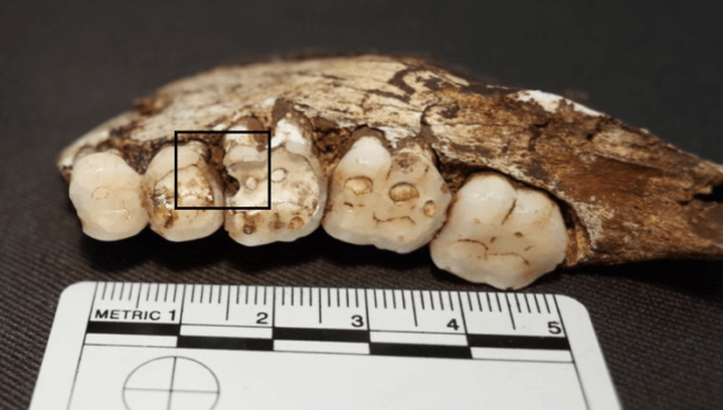 Сахар ни при чем: у наших древних предков были такие же проблемы с зубами. Фото.