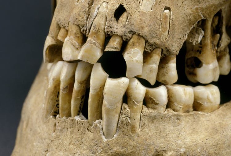 Сахар ни при чем: у наших древних предков были такие же проблемы с зубами. Фото.