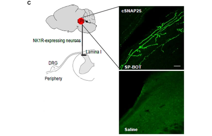 Представлено обезболивающее нового типа на основе ботокса. Фото.