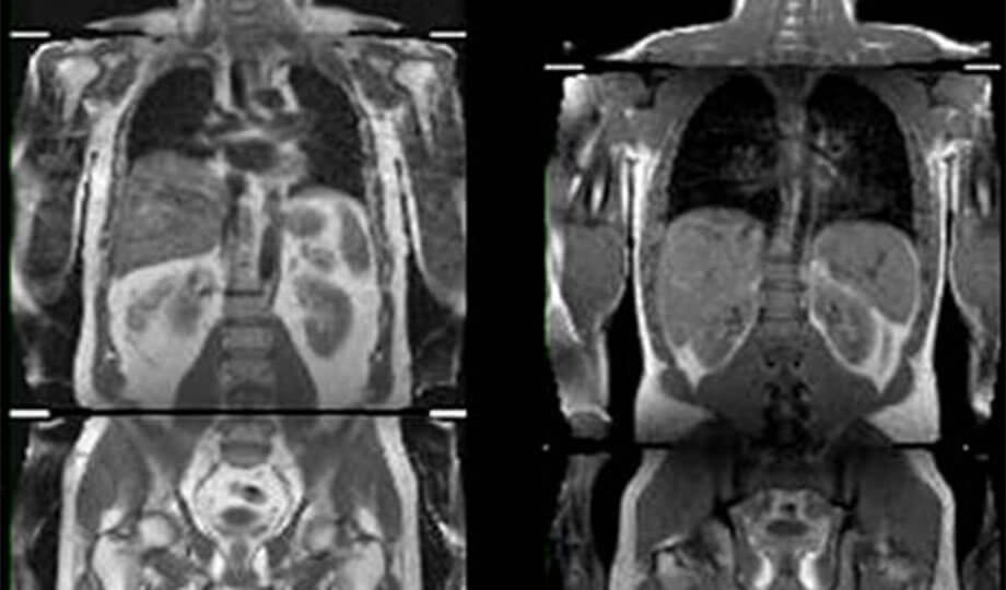 Генетические факторы ожирения защищают от диабета. Фото.