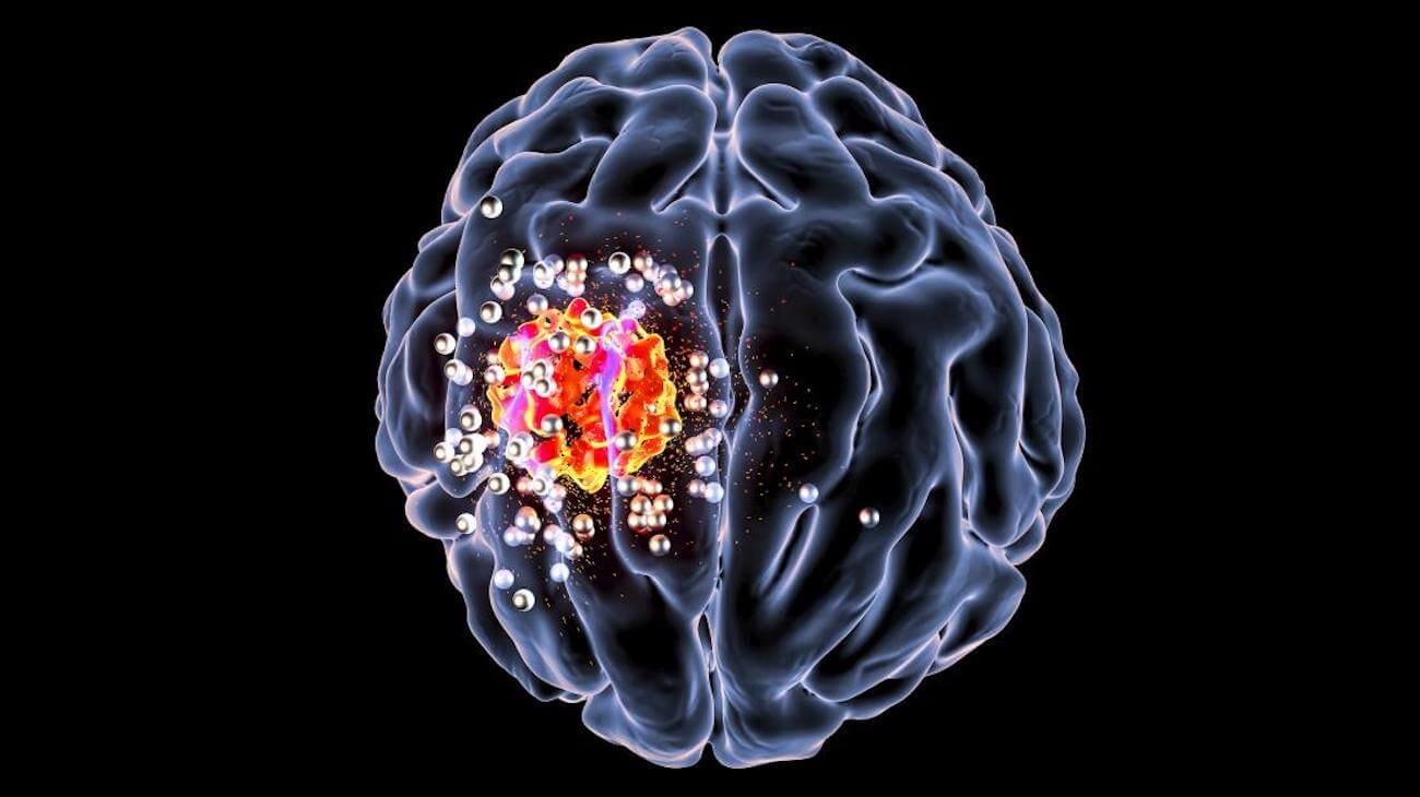 Особый светящийся элемент поможет в лечении опухолей головного мозга. Фото.