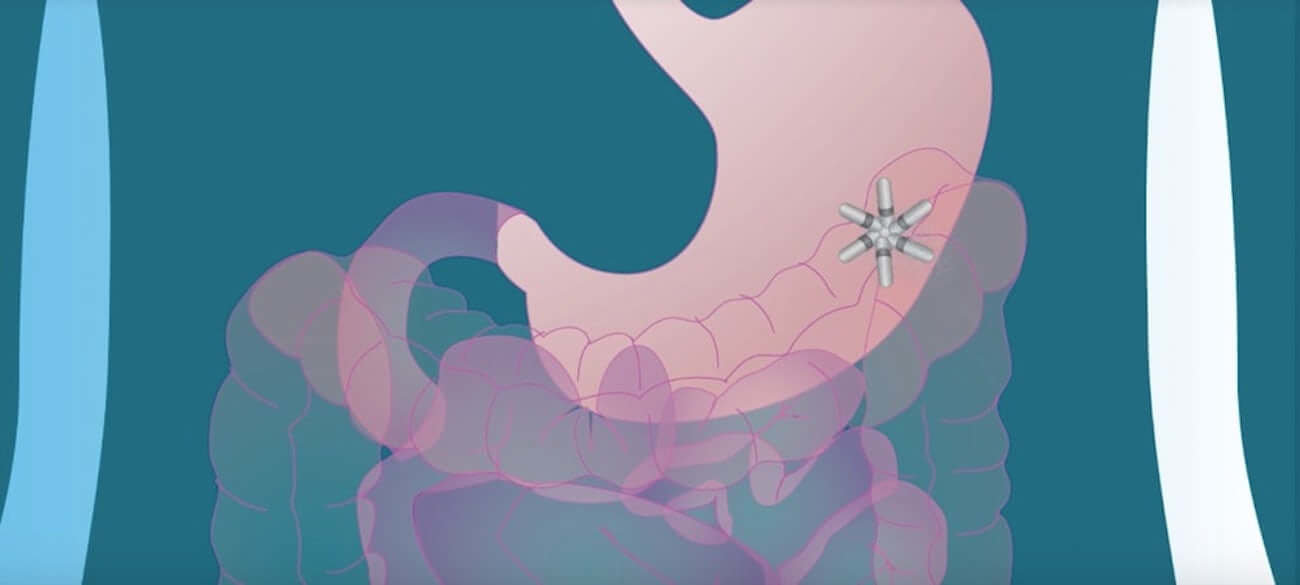 Мультидозовая капсула с лекарством прошла первые испытания на людях. Фото.