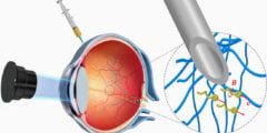 Нанороботов для лечения заболеваний впервые ввели в человеческий глаз. Фото.