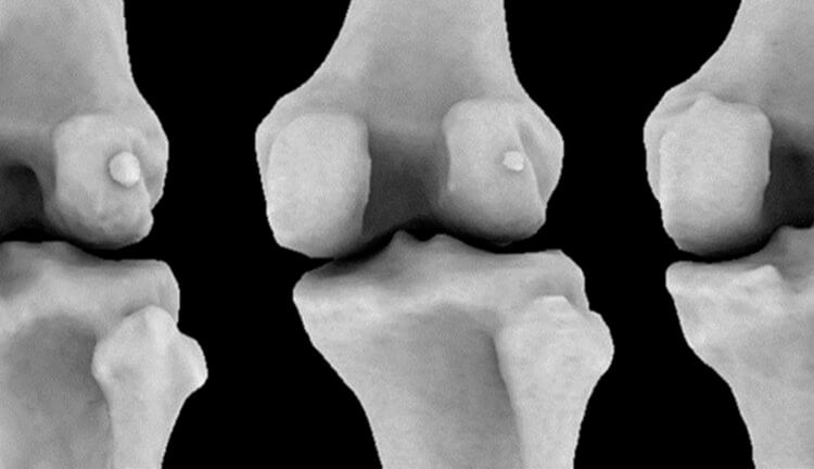 В телах современных людей нашли исчезнувшую в ходе эволюции кость. Фото.