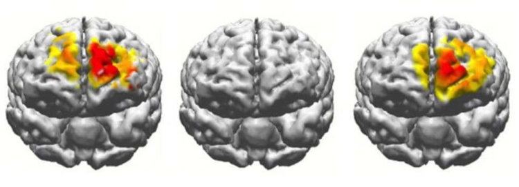 Электрическая стимуляция мозга временно омолаживает мозг человека на 50 лет. Фото.