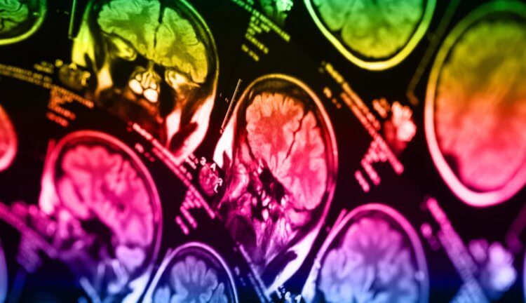 Склонность к суициду можно выявить при помощи сканирования мозга. Фото.