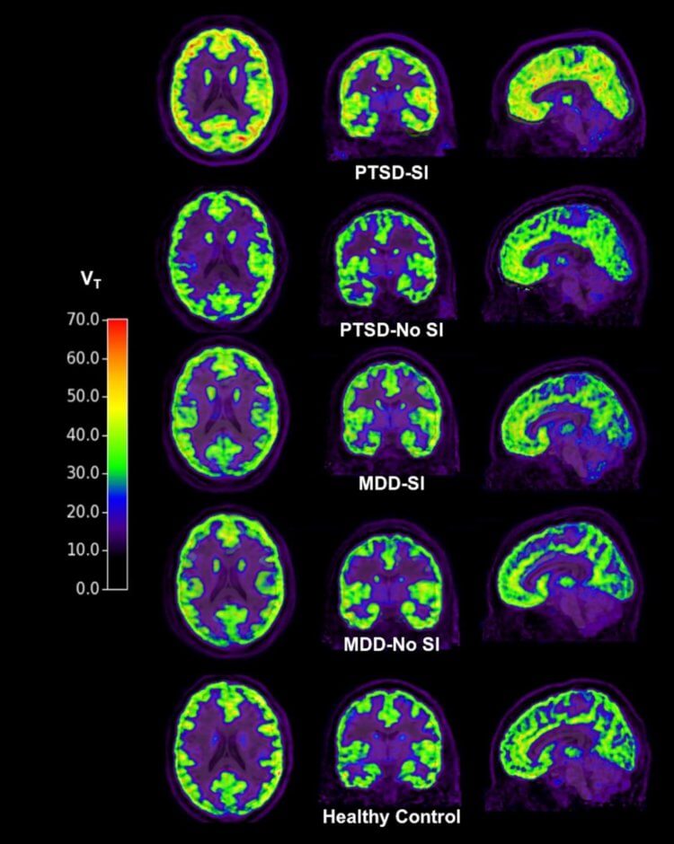 Склонность к суициду можно выявить при помощи сканирования мозга. Фото.