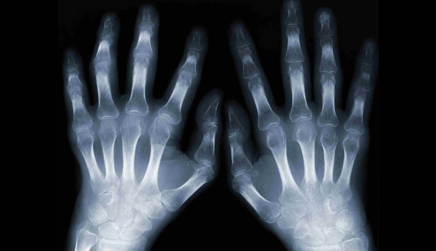 Космические путешествия приводят к долгосрочным проблемам с суставами. Фото.