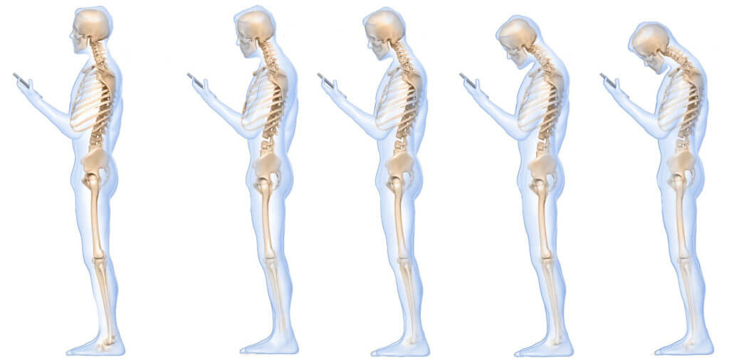 Почему важна правильная осанка? Изменение осанки имеет свойство прогрессировать. Почему важна правильная осанка? Изменение осанки имеет свойство прогрессировать. Фото.