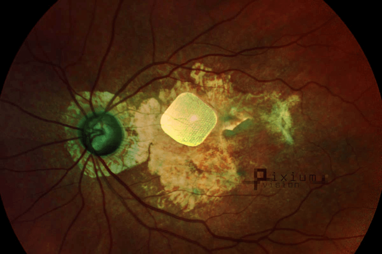 Бионический глаз вернул людям возможность читать. Как вернуть зрение. Фото.
