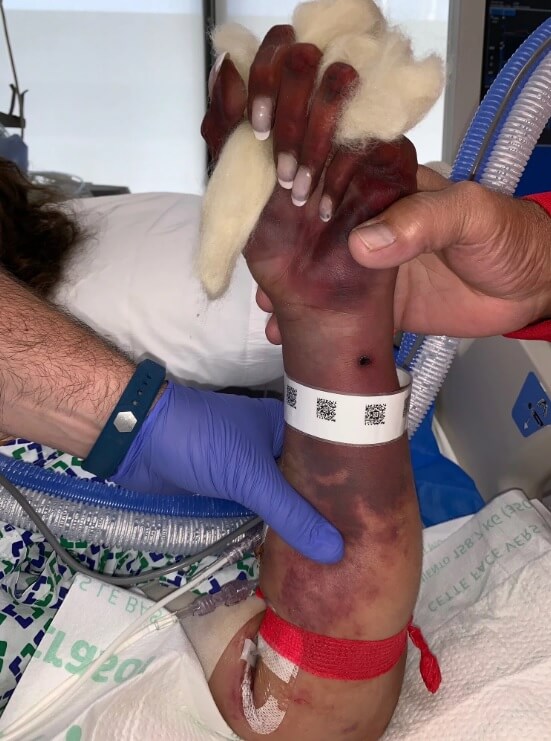 Американка лишилась рук и ног после того, как ее лизнула собака. Фото.
