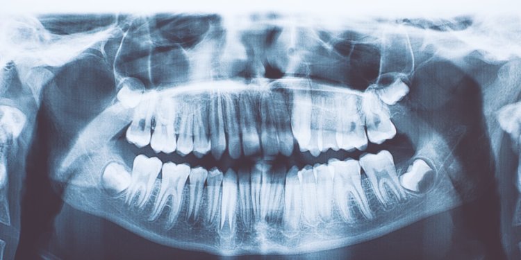 У индийского мальчика найдено 526 лишних зубов. Что это за болезнь? Фото.
