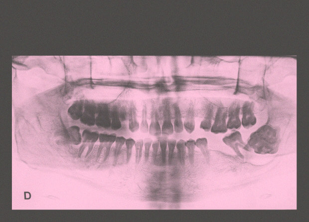 У индийского мальчика найдено 526 лишних зубов. Что это за болезнь? Почему возникают опухоли? Фото.
