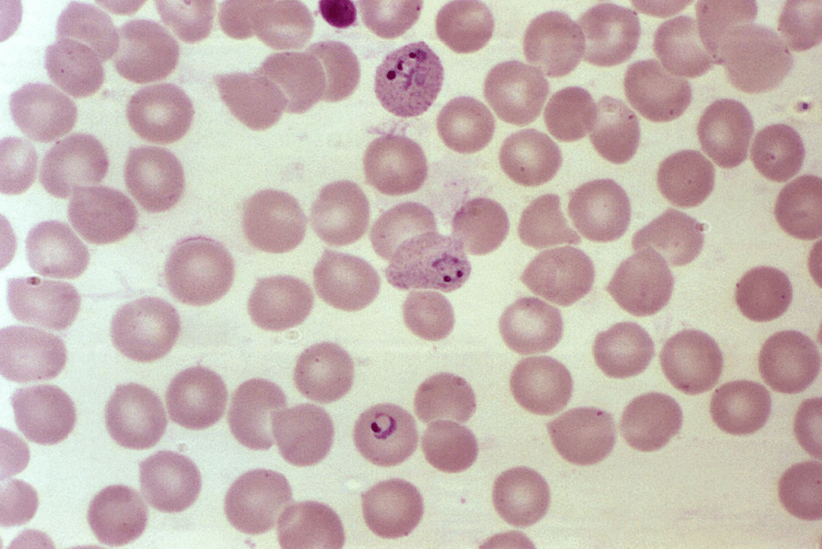 Что такое малярия? Вот так выглядит малярия в клетках крови. Фото.