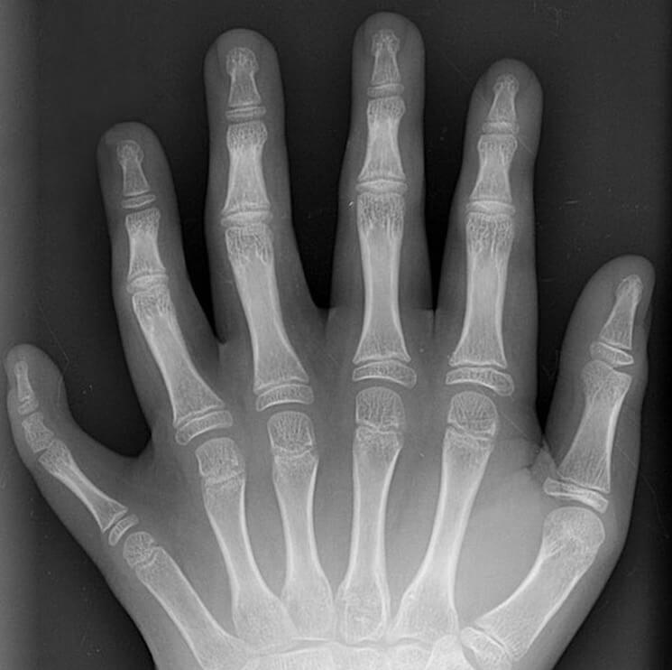 На что способно тело человека? Так выглядит рентген руки с шестью пальцами. Фото.