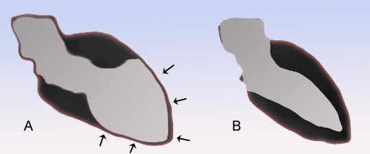 Что такое синдром Такоцубо? Сердце человека при синдроме Такоцубо (слева) и в обычном состоянии (справа). Фото.