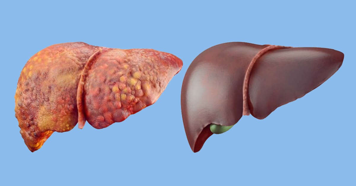 Печень часто употребляющего алкоголь человека (слева) и печень здорового человека (справа). Фото.