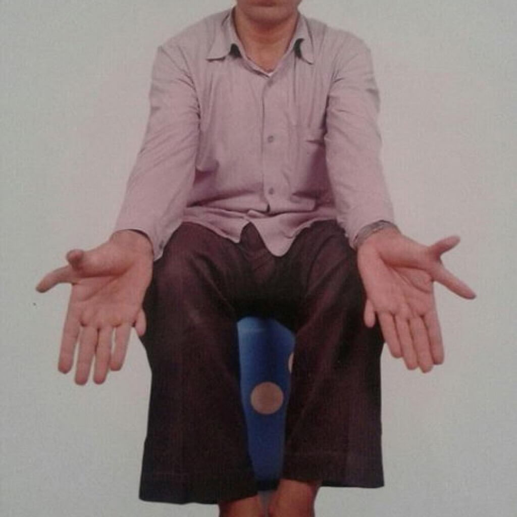 Человек с шестью пальцами? Так выглядят руки индийского плотника. На его ногах и руках по 14 пальцев. Фото.