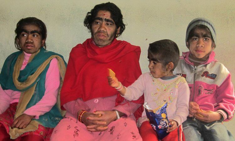 Можно ли вылечить “Синдром оборотня”? Семья Будхатоки из Непала, страдающая от гипертрихоза. Фото.