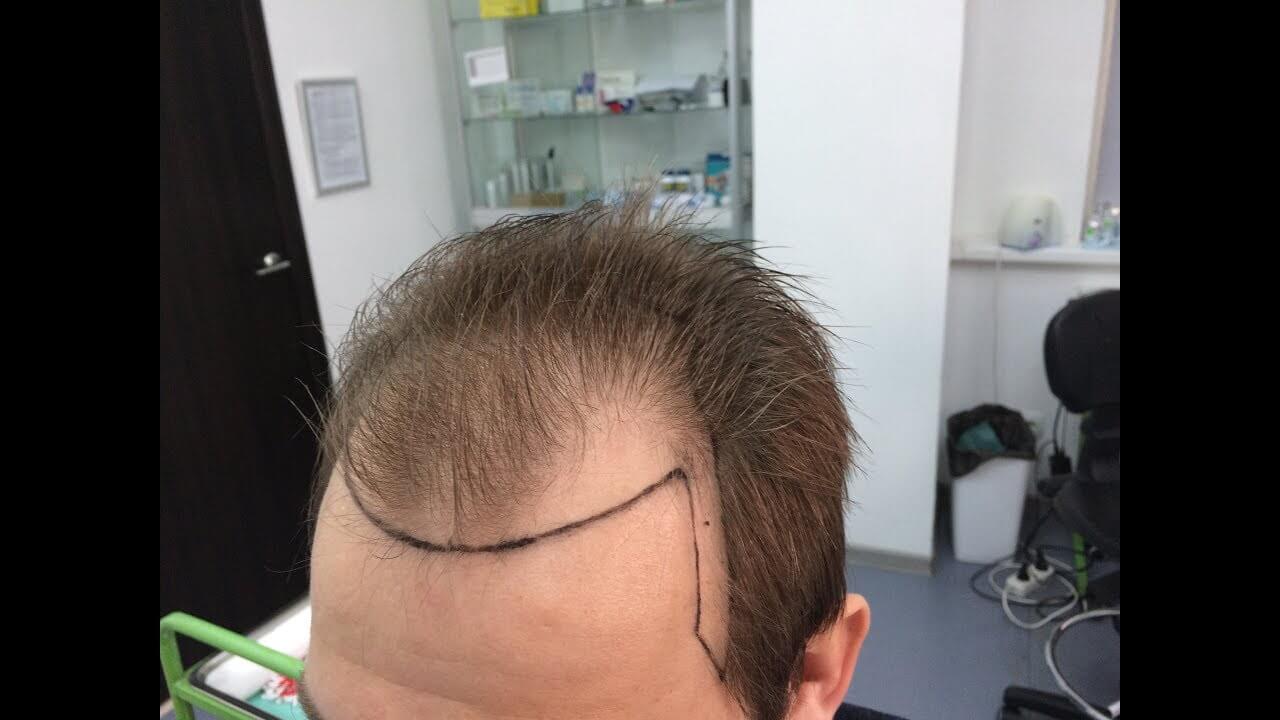 Так обозначают зону пересадки перед операцией. Фото.