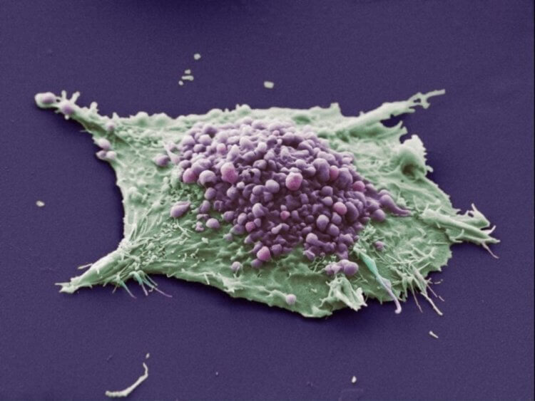 Как распространяется рак легких? Так выглядят раковые клетки. Фото.